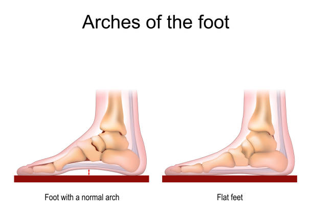 Understanding flat feet and footwear solutions